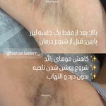 مرکز لیزر موهای زائد بهار