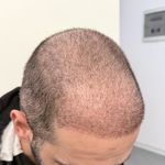 کلینیک کاشت مو سان