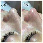 پاکسازی، فیشیال و جوانسازی نسترن