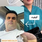 کلینیک کاشت مو صالحی