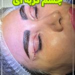 نارسیس سرجری