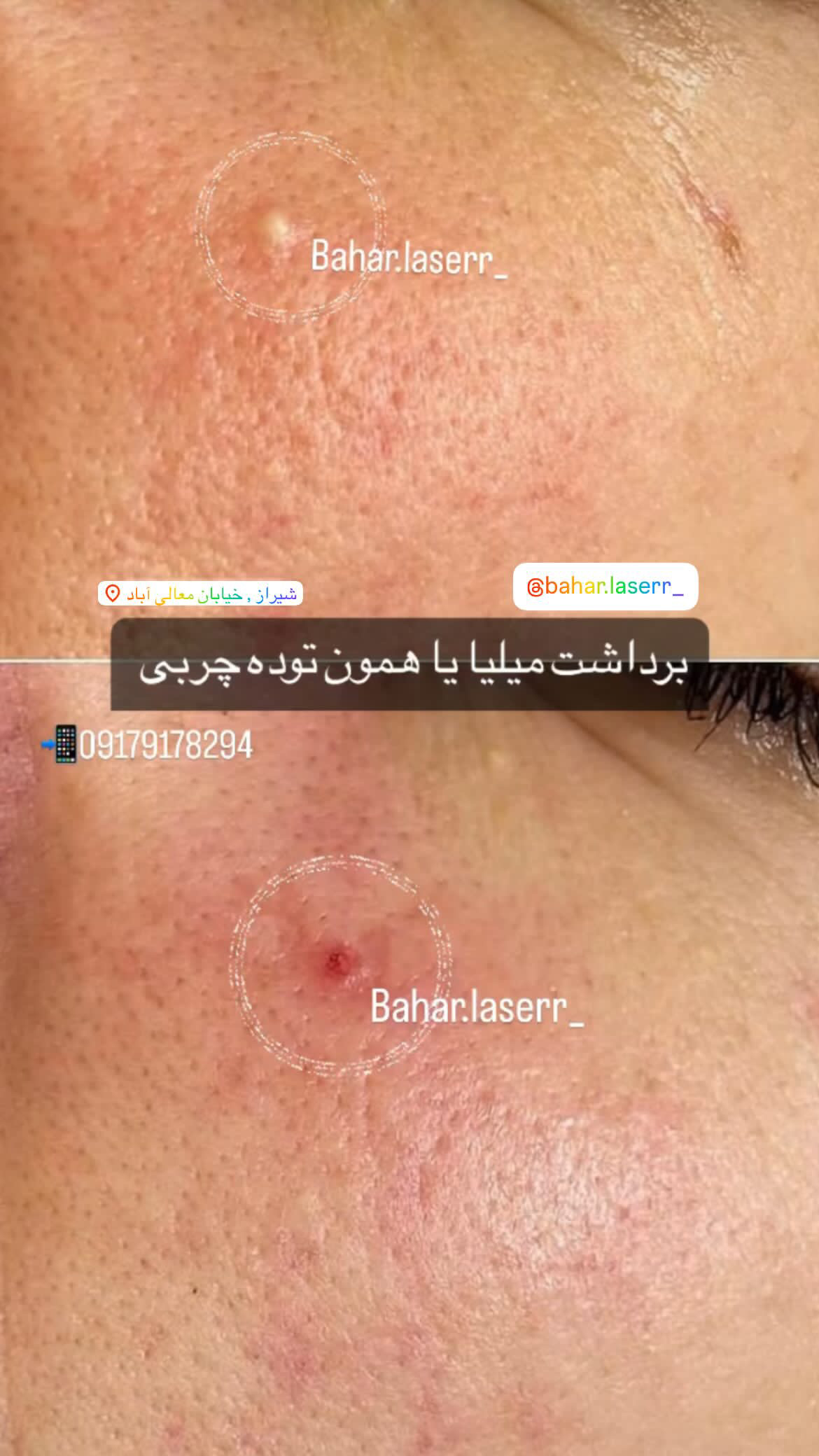 مرکز لیزر موهای زائد بهار